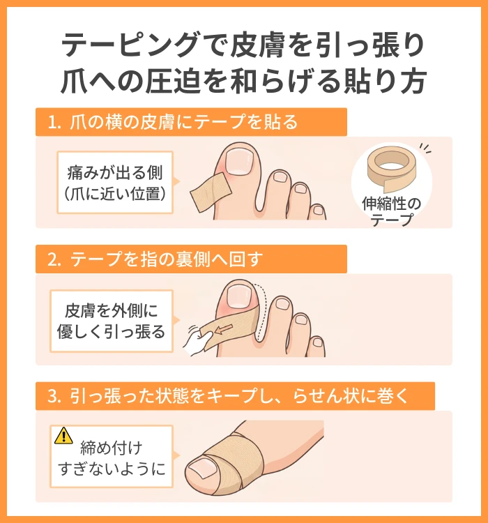 テーピングで皮膚を引っ張り爪への圧迫を和らげる貼り方